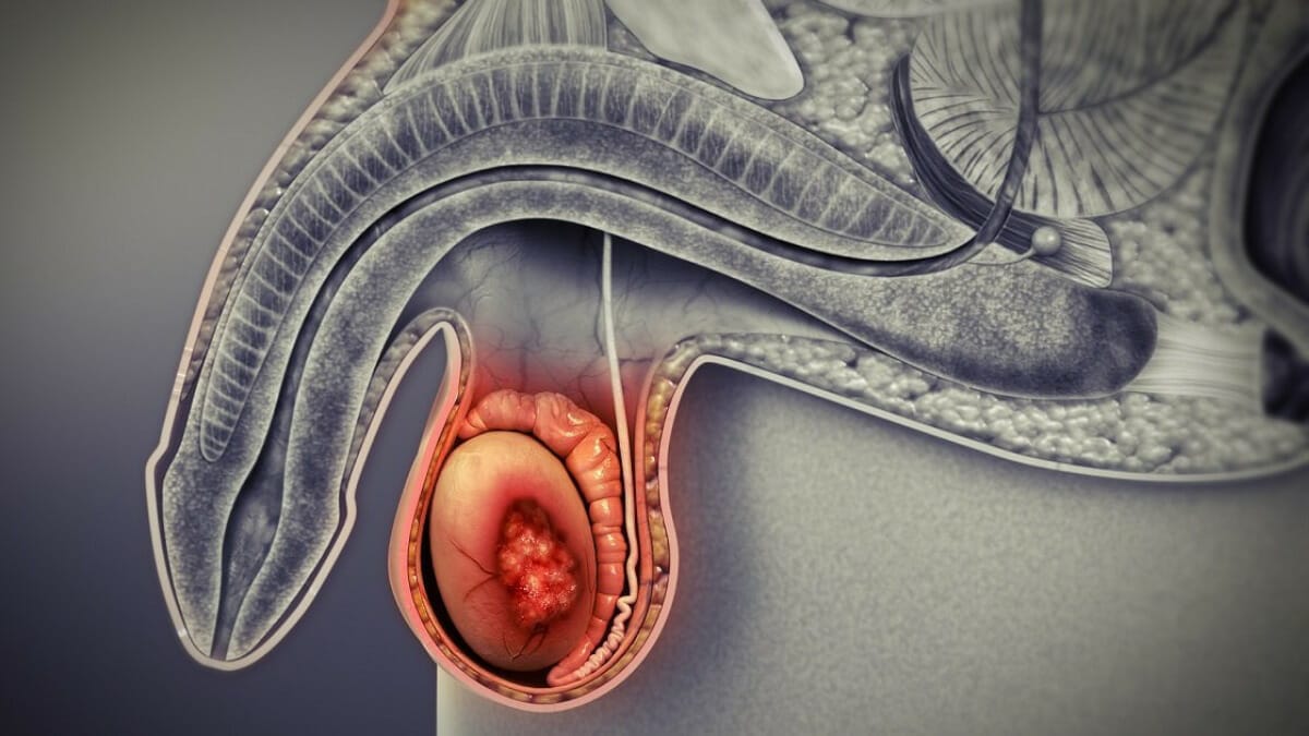 KANSER TESTIS AWAS JIKA ANDA ADA GEJALA INI!