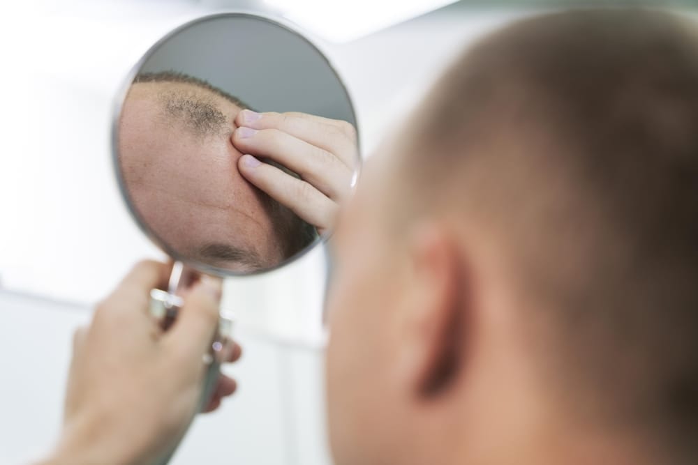 Selepas usia 50 tahun, lebih daripada separuh lelaki menunjukkan tanda-tanda kepala botak seperti rambut gugur teruk, rambut nipis ketara serta garis rambut semakin tinggi.