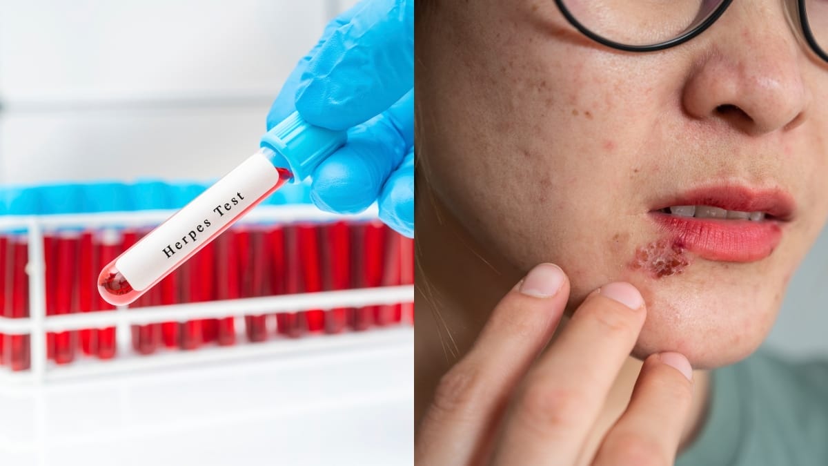 penyakit herpes boleh berlaku dalam rumah tangga